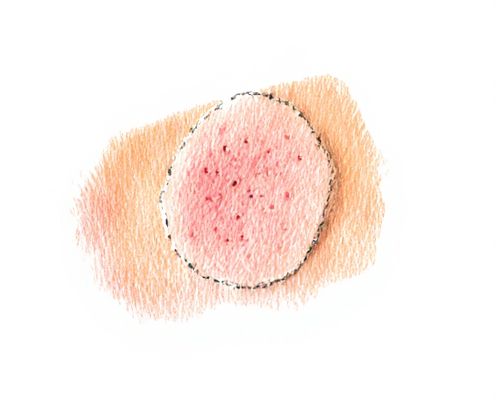 Pimple Patch Innovations in Cosmetic Skincare: Benefits, Ingredients, and Usage